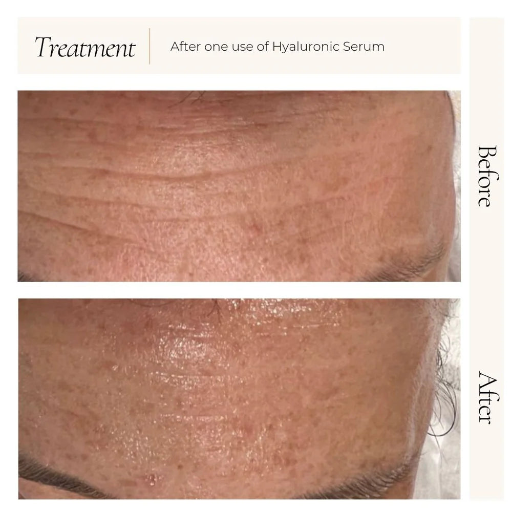 Before and after results of Le Mieux Hyaluronic Serum showing visibly smoother and more hydrated skin.