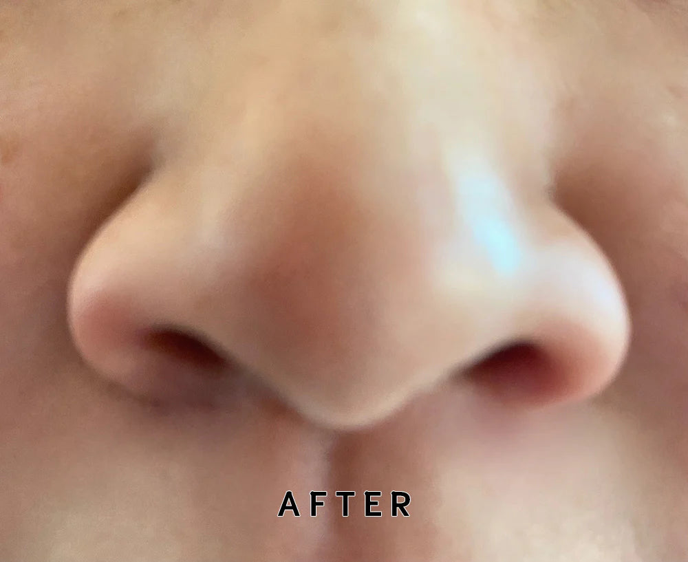 After using Palacia Ultrasonic Skin Scrubber showing visibly cleaner pores and smoother refined skin.