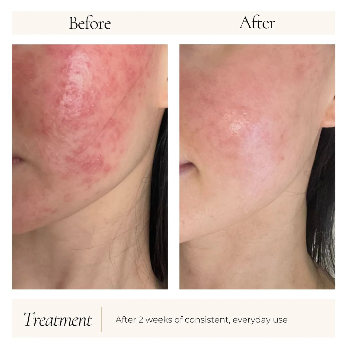Before and after results of Le Mieux Iso-Cell Recovery Solution - reduced redness and improved skin appearance after 2 weeks of use. 
