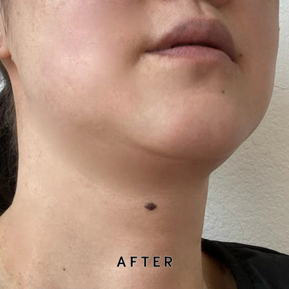 After treatment photo for Ultrasonic Anti-Aging Face Lifting Machine - improved firmness and smoother skin under chine and jawline. 