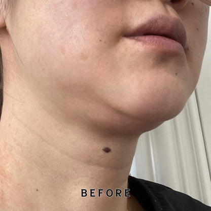 Before treatment photo for Ultrasonic Anti-Aging Face Lifting Machine - showing sagging skin and lack of firmness under chine and jawline. 